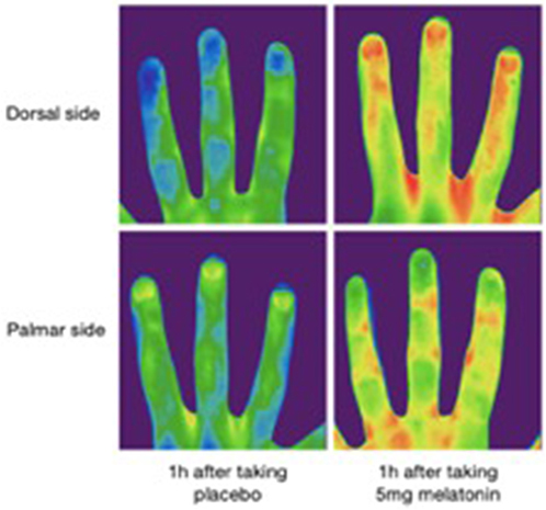Figure 3 Effect of immediate release melatonin on distal vasodilatation. Illustration of the analysis of the topographic temperature with infrared thermometry in an individual (dorsal and palmar side of the hand) 1 h after taking a placebo and 1 h after taking 5 mg of immediate release melatonin (oral intake), the latter indicating a greater increase in skin blood flow by melatonin in the fingertip than in the proximal finger, most likely by opening arteriovenous anastomoses. Immediate release melatonin administration during the day (absence of endogenous melatonin secretion) mimics the endogenous thermophysiological processes that occur in the evening and induces sleepiness. Adapted from Kräuchi K, Cajochen C, Pache M, Flammer J, Wirz‐Justice A. Thermoregulatory effects of melatonin in relation to sleepiness. Chronobiol Int. 2006;23(1–2):475–484, Taylor & Francis Ltd, http://www.tandfonline.com by permission of the publisher.Citation32