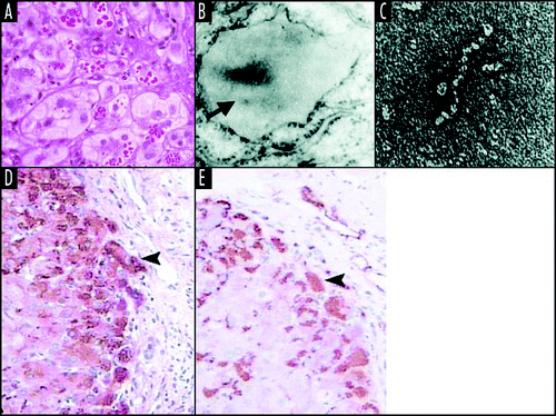 Figure 2 Z α1-antitrypsin is retained within hepatocytes as intracellular inclusions. These inclusions are PAS-positive and diastase resistant (A) and are associated with neonatal hepatitis and hepatocellular carcinoma. (B) Electron microscopy of a hepatocyte from the liver of a patient with Z α1-antitrypsin deficiency shows the accumulation of α1-antitrypsin within the rough ER (arrow). These inclusions are composed of chains of α1-antitrypsin polymers shown here from the plasma of a Siiyama α1-antitrypsin homozygote (C). More recently, polymers have been identified within PAS-positive inclusions with a monoclonal anti-polymer α1-antitrypsin antibody. (D and E) Immunochemistry of the liver from an individual with Z α1-antitrypsin deficiency, showing staining with an anti-α1-antitrypsin polyclonal antibody (D, arrow) and a monoclonal anti-polymer α1-antitrypsin antibody (E, arrow). It is these intracellular inclusions of polymers that are associated with neonatal hepatitis and hepatocellular carcinoma. Figure reproduced with permission from Lomas et al.Citation97