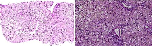 Figure 5 Histopathological findings for patient II-1 in family F3. Hematoxylin and eosin staining showing hepatocytes ballooning and feathery changes with marked intrahepatic cholestasis. Mild periportal inflammation and foci of spotty necrosis are also present (magnification: 100× and 200× left to right, respectively).