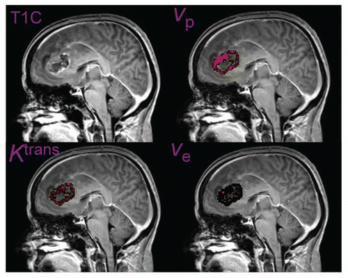 Figure 4 Postcontrast image (T1C), endothelial transfer constant (Ktrans), extracellular extravascular space (ve) and blood plasma volume (vp) maps obtained using DCE MRI in a patient with a glioblastoma multiforme. Courtesy of Drs. Geoffrey Parker and Samantha Mills, University of Manchester, UK.