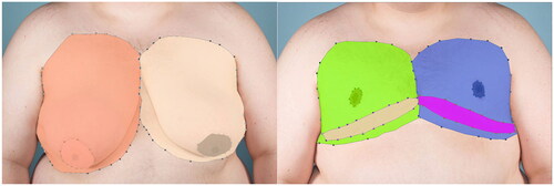 Figure 3. Study images examples of trans male patient’s chest (a) pre and (b) post-DIFNG. All images were processed individually by hand, using predetermined landmarks, to assign 6 symmetric AOIs based on key breast.