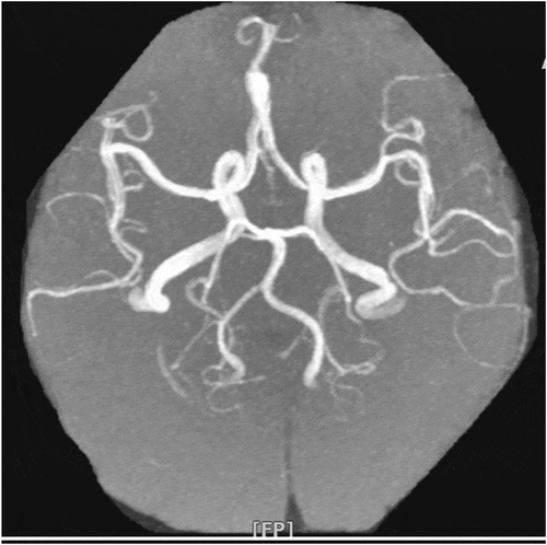 Figure 2. Magnetic resonance angiography of the brain. 3D time of flight MRA of the Circle of Willis is obtained without contrast. The vertebrobasilar junction is normal. The anterior and posterior circulations are within normal limits. There are no aneurysms, AVMs, or intravascular stenosis