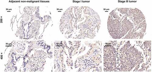 Figure 1. Elevated GSG2 was detected in NSCLC tumor tissues relative to para-carcinoma tissues by immunohistochemical staining analysis.