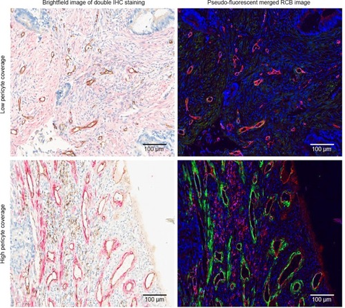 Figure 1 Double IHC staining and image analyses of mCRC tissue.Notes: Tissue sections were stained with anti-CD31 antibody (brown in the brightfield IHC images, red in the pseudo-fluorescent merged RGB images) and anti-α-SMA antibody (red in the brightfield IHC images, green in the pseudo-fluorescent merged RGB images). Brightfield and pseudo-fluorescent RGB images are shown to highlight the intensity of the staining. Scale bars, 100 µm.Abbreviations: IHC, immunohistochemical; mCRC, metastatic colorectal cancer; CD31, cluster of differentiation 31; RGB, red-green-blue; α-SMA, alpha-smooth muscle actin.