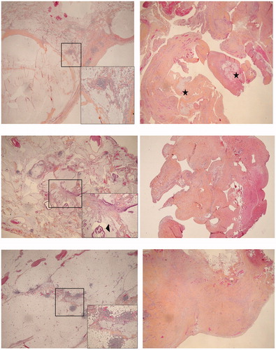 Figure 3. Example of histological samples from the two-stages.. (a) Patient 5 (a1) Stage I, parietal peritoneum involved by pools of acellular mucin, assessed as low-grade mucinous carcinoma peritonei (pseudomyxoma peritonei). HES, magnification × 20. Insert: evidence of acellular mucin with a reactive lymphocytic infiltrate. HES, × 100. (a2) Stage II, mesenteric peritoneum sampling showing a fibrous scar tissue embedding inconspicuous residual acellular mucin (asterisks). HES, × 20. (b) Patient 6 (b1) Stage I, parietal peritoneum involved by pools of extracellular mucin along with low grade neoplastic epithelium, assessed as low-grade mucinous carcinoma peritonei. HES, × 20. Insert: neoplastic epithelium highlighted by arrowheads. HES, × 100. (b2) Stage II, mesenteric peritoneum sampling showing merely fibrous scar tissue. HES, × 40. (b) Patient 8 (c1) Stage I, parietal peritoneum involved by pools of acellular mucin (low-grade mucinous carcinoma peritonei). HES, × 20. Insert: evidence of acellular mucin with a reactive lymphocytic infiltrate. HES, × 100. (c2) Stage II, mesenteric peritoneum sampling showing merely fibrous scar tissue. HES, × 40. HES: Hematoxylin eosin saffron.