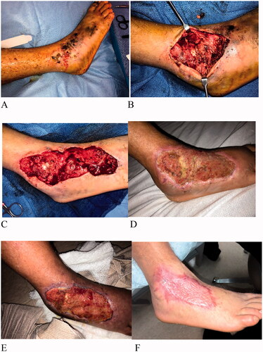 Figure 1. Case 1. A 34-year-old male while riding a bicycle was hit by motorcycle. He suffered soft tissue injury on the right foot. The wound on the foot (A) had exposed bone and joint (B) and was debrided, prior to matrix placement (C). A sheet of IMBWM was applied to the wound. Vascularization of the dermal matrix occurred sequentially (D) and was complete 9 weeks after matrix placement (E), at which time the silicon layer was removed and STSG was applied. STSG take 100% was observed after 1 week (F).