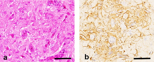 Figure 1. Nodular astrocytic growth in the brain of a chicken inoculated in ovo with 5 × 104 TCIU Sp-53. 1a: Protoplasmic astrocytes proliferate around vessels. Haematoxylin and eosin stain. Bar = 20 µm. 1b: Astrocytes of nodules show positivity for glial fibrillary acidic protein. Immunohistochemistry. Bar = 20 µm.