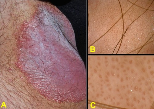 Figure 5 Inverse psoriasis of the right inguinal fold in 46-year-old man (A); x10 dermoscopy shows homogeneously distributed “red dots” on an erythematous background (B); x150 dermoscopy shows typical “bushy” capillaries.