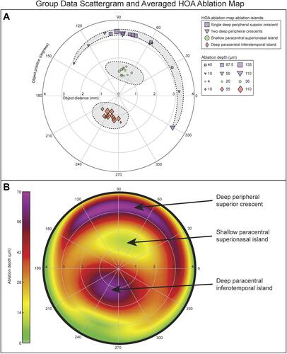 Figure 4 (A) Group data of the four ablation islands. The yellow/green superonasal ablation islands (island #2; green circles) and the red/purple inferotemporal ablation islands (Island #3; red diamonds) were highly reproducible in terms of distance from center and angular position, while their ablation depth varied more. The distance from center of the deep peripheral ablation islands (Island #1 and Island #4; purple markers) was highly reproducible, with a larger range of depth. (B) Composite HOA ablation map obtained by averaging the HOA ablation map of all 12 KC cases.