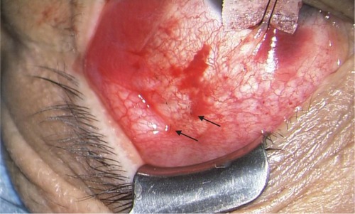 Figure 2 Surgical procedure of conjunctival fixation to the sclera. Conjunctiva was fixated to the sclera with 8–10 interrupted sutures of 10-0 nylon in two rows (arrows) located approximately 12–14 mm posterior to the limbus.