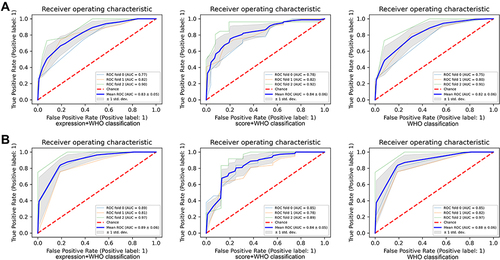 Figure 8 The prognostic value of NOD1 expression combining WHO classification in TMA cohort. (A) The ROC and AUC of NOD1 with WHO classification for 5-year DFS. (B) The ROC and AUC of NOD1 with WHO classification for 5-year OS.