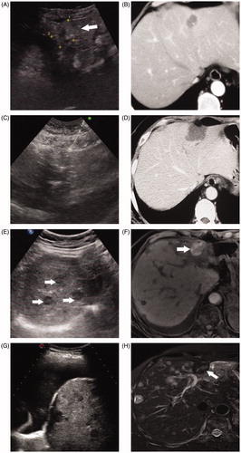 Figure 6. A 54-year-old woman with breast cancer liver metastasis (BCLM) underwent radiofrequency ablation (RFA) treatment. (A) Ultrasound before RFA showed a 3.1 cm tumor in segment II of liver (↑). The tumor was diagnosed as BCLM-moderately differentiated adenocarcinoma by ultrasound-guided biopsy. (B) Contrast-enhanced CT before RFA showed a 3.1 cm tumor in segment II of liver. (C) Ultrasound in 53 months after first RFA showed the second RFA was performed for the new liver metastasis in segment III. (D) Contrast-enhanced CT in one month after RFA showed that ablation zone had non-enhancing. (E) Ultrasound in 80 months after first RFA showed multiple new intrahepatic metastases (↑). The patients underwent chemotherapy. (F) Magnetic resonance imaging (MRI) in 80 months after first RFA confirmed that ablation area had non-enhancing (↑). (G) Ultrasound in 92 months after first RFA showed massive pleural effusion. (H) MRI in 95 months showed the ablation zone had non-enhancing but other liver metastasis had no response to chemotherapy treatment. This patient survived more than eight years post treatment and died due to the disease progression.