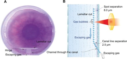 Figure 1 Illustration of the gas venting chimney mechanism for the FS200 femtosecond laser. (A) Top view, intraoperative surgeon’s view. The canal and hinge are at the 12 o’clock position. (B) Artist’s rendering of the channel through the canal created during the procedure.