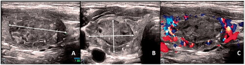 Figure 1. Ultrasonographic measurement and color Doppler sonography of thyroid solid nodule. Ultrasonography of a 28-year-old woman with solid nodules in the right lobe of the thyroid gland. (A) Solid nodule in the right lobe of the thyroid; the length diameter of the nodules was measured in the longitudinal section. (B) The left and right diameters and anteroposterior diameters of the nodules were measured in cross section. (C) Color Doppler sonography of solid thyroid nodules.