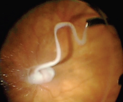 Figure 1 Injection of triamcinolone during vitrectomy.