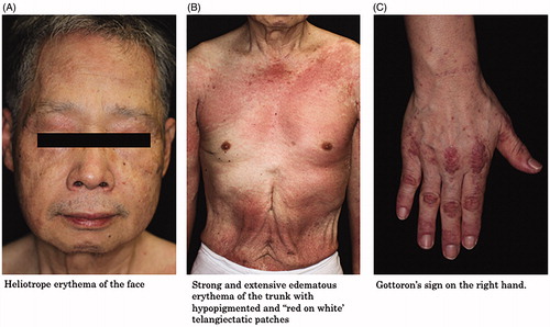 Figure 3. Cutaneous manifestations of anti-TIF1γ antibody-positive DM. (A) Heliotrope erythema of the face. (B) Strong and extensive edematous erythema of the trunk with hypopigmented and ‘red on white’ telangiectatic patches. (C) Gottoron’s sign on the right hand.