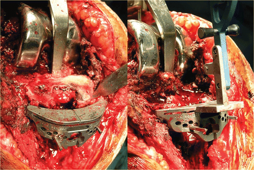 Figure 4. Operative view showing the navigation of the tibial cut. [Color version available online.]