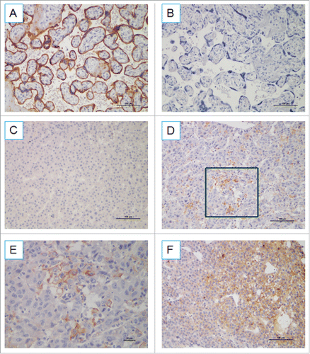 Figure 2. PD-L1 expression pattern in FFPE samples stained with anti-PD-L1 antibody. (A) Placenta was used as a positive control for PD-L1 expression. (B) Isotype control. (C) Samples displaying pattern 1 exhibited negative expression in HCC cells. Original magnification, ×200. (D) Samples exhibiting pattern 2 displayed focal staining, original magnification, ×200. (E) Original magnification of the boxed area shown in (D), ×400 (F) Samples displaying pattern 3 exhibited diffuse PD-L1 expression (> 40% tumor PD-L1). Original magnification, ×200.