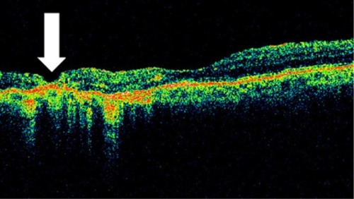 Figure 36 Retinal thinning (arrow) corresponding to retinal atrophy can be defined by Stratus optical coherence tomography, in the region of photocoagulation treatment.