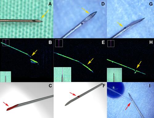 Figure 2 Overview of the two needle types used in the experimental study. Enlarged view of the standard hypodermic needle (SHN) 30 G (A–C) and the newly designed needle (NDN) 30 G (D–I). Yellow arrow indicates the presence of a front tip orifice in the SHN (A). iOCT of the SHN 30 G needle (B) and NDN 30 G needle (E and H). (B) Yellow arrow indicates the sharp inner edge of the tip of the SHN. Yellow arrows indicate absence of the tip orifice (D and E) and the side port (G and H). (C and F) Schematic view of the cellular content (red arrows) captured by the SHN 30 G and NDN 30 G needles, respectively. (I) The direction of the injection stream of the NDN (red arrow). (Created by L. Lytvynchuk.)