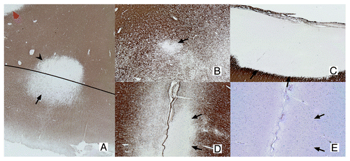 Figure 1.Classification of GM lesions as described by Bö et al.Citation8 Type I lesions (A) are GM/WM mixed lesions (original magnification 2.5x). The black line indicates the border between WM and GM. The GM and WM parts of the lesion are indicated with an arrow and arrowhead, respectively. The red arrowhead indicates a WM lesion. Type II lesions (B) are located completely intracortically, while type III and IV lesions run from the pial surface toward deeper cortical layers (D and E) or all the way to the GM/WM border, respectively (C; original magnification 5x). Both D en E are sections showing the same type III lesion. The lesion is visible in the MBP staining (D), showing a clearly demyelinated area (arrows indicate lesion borders), while the same area is invisible in a consecutive slide stained with a more conventional histochemical staining (E; Luxol Fast-Blue). The original magnification is 5x. (A-D), sections stained using myelin basic protein (MBP) antibodies. (E) Section stained using LFB.