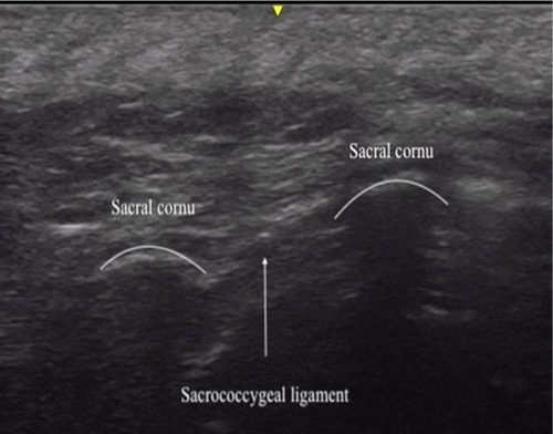 Figure 1 Transverse ultrasound image of the sacrum at the level of the sacrococcygeal ligament showing the ligament and the sacral cornu.