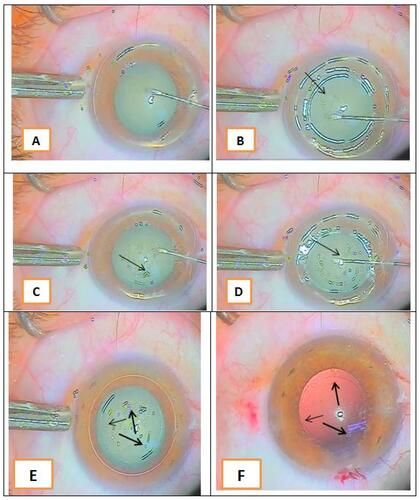 Figure 1 (A) Starting capsulorhexis; (B) multiple light reflection rings at different tissue levels (arrow shows the capsulorhexis edge); (C) progression of capsulorhexis guided by light reflection at the torn capsular edge (arrow shows the capsulorhexis edge); (D) closing of capsulorhexis (arrow shows the capsulorhexis margin to the end of the circle); (E) arrows showing the completed circular capsulorhexis; and (F) arrows showing the complete capsulorhexis against a red reflection after phacoemulsification.