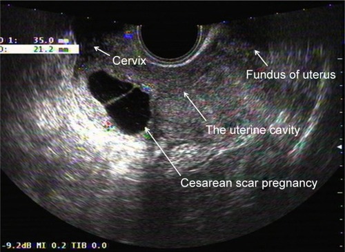 Figure 1 Transvaginal ultrasound scan showing empty uterine cavity and empty cervical canal with a gestational sac in anterior myometrium of lower uterine segment.