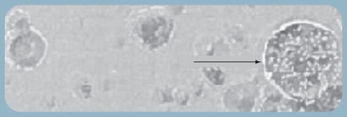 Figure 1. Activated macrophages (arrow) exposed in vitro to Kenalog® were unable to digest and eliminate triamcinolone acetonide crystals.The macrophages expanded in size, rupturing and releasing proinflammatory cytokines.Reprinted with permission from Jeffrey Edelman (Allergan Inc., CA, USA).