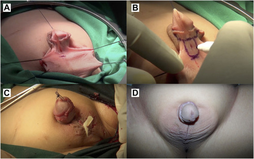 Figure 1 Island onlay flap technique. (A) Patient pre-operative proximal hypospadias clinical appearance. (B) Surgical site marking on the patient penis. (C) Post-operative clinical appearance of patient. (D) One-month post-operative follow-up of the patient.