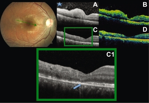Figure 4 Baseline fundus photography. Radial scans at baseline (A, B) and after six weeks (C, D). Increased thickness at the perifoveal lesion both by SD-OCT and TD-OCT. Hyper-reflective vitreous dots (asterisk) better seen in A. Decrease of the retinal thickness and disorganization of the layers are seen at follow up. Interruption of the IS/OS junction of the photoreceptor band: arrowhead C, C1.
