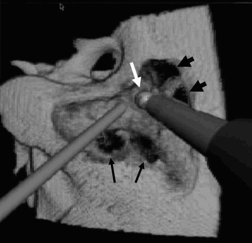 Figure 5. During the drilling, some bleeding is simulated (arrows). A deeper excavation allows unroofing of the sigmoid sinus (arrowheads). The drill burr is opening the mastoid antrum (white arrow).