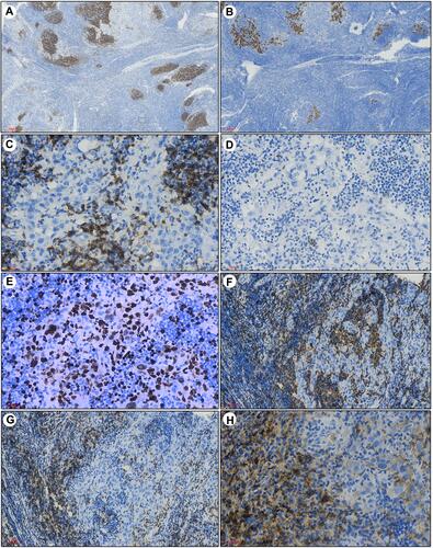 Figure 2 Immunohistochemistry for CD21 showed a markedly smaller network of follicular dendritic cells in the germinal centers (A, 40×). CK-pan staining demonstrated the nests of carcinoma cells surrounded by lymphocytes (B, 40×). The carcinoma cells were negative for CD5 (C, 400×) and p63 (D, 400×), and the Ki-67 index was extremely high (E, 400×). The large undifferentiated cells within the follicles were surrounded by lymphocytes positive for CD20 (F, 400×) and CD3 in perifollicular areas (G, 400×). Abundant plasma cells in the interfollicular areas were positive for CD138 (H, 400×).