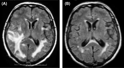 Figure 1. (A) Axial magnetic resonance imaging (MRI) obtained at admission shows bilateral predominantly parieto-occipital subcortical hyperintensities. (B) Follow-up MRI performed 15 days later showing marked reduction of MRI abnormalities.