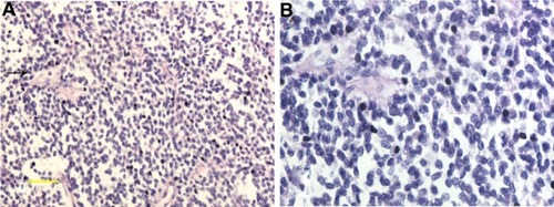 Figure 2 Histological findings. (A) Tumor composition – a diffused distribution of small round cells, with scattered Homer Wright rosettes (indicated by the arrow); (B) high-power microscopy revealed that the small round cells with round nuclei contained fine chromatin and there was limited clear or eosinophilic cytoplasm.