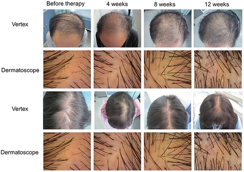 Figure 3 Comparison among patients with alopecia in terms of head Top hair volume and dermoscopy during treatment.