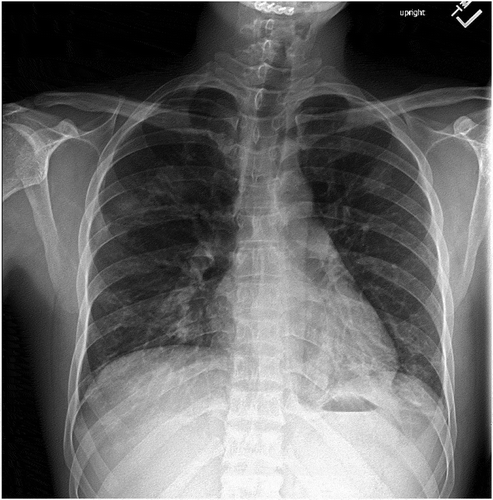 Figure 1. Chest X-ray PA view showing multifocal pneumonia.