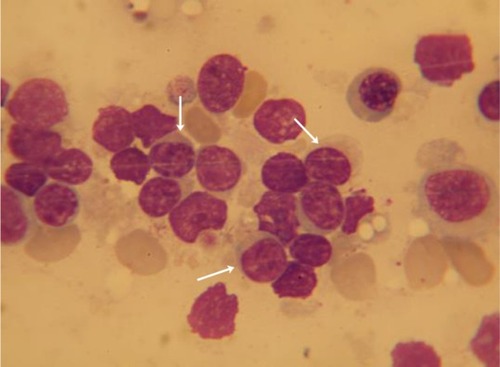Figure 1 Bone marrow examination showing infiltrate with cells of lymphoid morphology, intact (arrows), or smudged.