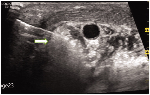 Figure 5. The patient received MWA ablation of metastatic lymph nodes in July 2016. Ultrasound monitoring showed that some lymph nodes were covered by microbubbles.