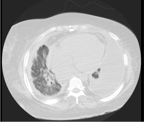 Fig. 3 Chest CT (lung window) at lower lung field showing b/l lower lung pleural effusion, more on the left, and cardiomegaly.