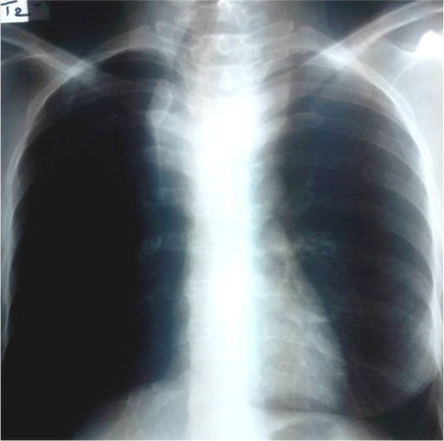 Fig. 1 Chest radiography: enlargement of the superior mediastinum with right tracheal deviation.
