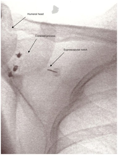 Figure 3 Radiofrequency cannula placed in the classic U-shaped notch with the patient in the prone position.