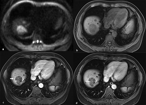 Figure 6 A 54-year-old male patient with hepatitis B–related liver cirrhosis and HCC is categorized as LR-M category. A 40-mm nodule shows heterogeneous hyperintensity on (a) diffusion weighted imaging. (b) T1-weighted imaging shows heterogeneous hypointensity in hepatic segment VIII. It presents rim arterial phase hyperenhancement (arrow) on contrast enhanced T1-weighted imaging (c) with contrast agent Gd-DTPA, resulting in delayed central enhancement (arrow) in (d) the delayed phase.