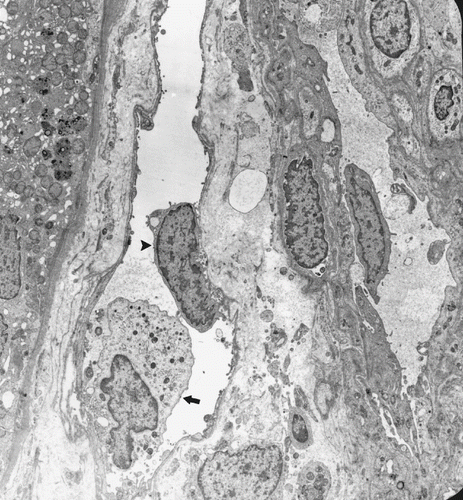Figure 4. An MN cell (arrow) and detached endothelial cell (arrowhead) in a PC. (Uranyl acetate, lead citrate 2156X).
