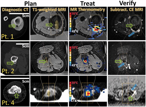 Figure 4. MR-HIFU ablation of osteoid osteoma: from diagnosis to post-treatment imaging. Patients 1, 2 and 4 had lesions in the tibia, the femur, and the phalanx, respectively. Columns 1 and 2: Pre-procedure planning was performed using available diagnostic CT and MRI imaging. Note that the length of the 5-cm scale bar differs among patients, highlighting the size difference between the targeted limbs. Green arrows indicate the location of OO nidus. Pre-treatment T1-weighted high-resolution MRI dataset was used to plan treatment. Column 3: MRI thermometry allowed for monitoring of heating during treatment (temperature at the end of sonication is shown). Column 4: Resulting lack of perfusion was evaluated using a subtraction image of MRI contrast enhancement. Blue arrows mark oedema immediately after treatment and a contour surrounds areas of lethal thermal dose.