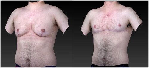 Figure 1. Results after the breast reduction and sequential gender-affirming mastectomy at one year follow-up.