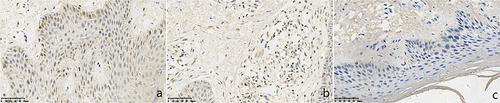 Figure 3 Expressions of TLR7 in chronic eczema lesions and the perilesional normal skin at the edge (SP *400). (a) Epidermic of skin lesion. (b) Dermis of skin lesion. (c) Perilesional normal skin. (a) A few TLR7+ cells with brown cytoplasm were observed in the epidermal of chronic eczema lesions. (b) A few TLR7+ cells with brown cytoplasm were observed in the dermal papillary layer of chronic eczema lesion. (c) Few TLR7+ cells with brown cytoplasm were observed in both epidermal and papillary layer of perilesional normal skin of the lesion.