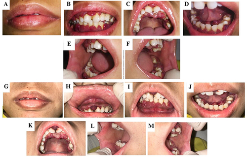 Figure 2 (A–F) The first follow-up visit. (G–M) The second follow-up visit. There has been no clinical change in the gingiva.