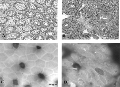 Fig. 2 (A, B) Hematoxylin and eosin stain of normal colon (A) and IBD (B), ×200. (C,D) Using wet tissue for SEM: (C) “en face” SEM photograph of normal colon; (D) “en face” SEM photographs of colon affected by Crohn disease show marked irregularity of the cell borders with elongation of the crypts’ orifices, ×3200.