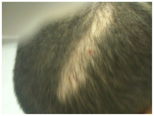 Figure 1 Initial presentation of alopecia on the scalp of an 11-year-old boy.